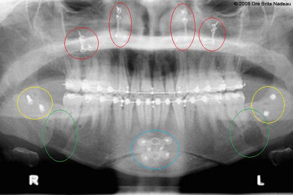 Marie-Hélène Cyr - Panoramic X-ray after my orthognathic surgeries (April 22, 2008)